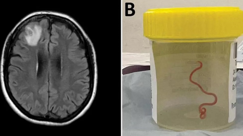 विश्वमै पहिलो पटक मानिसको मस्तिष्कमा ८ सेन्टिमिटर लामो जीवित किरा भेटियो