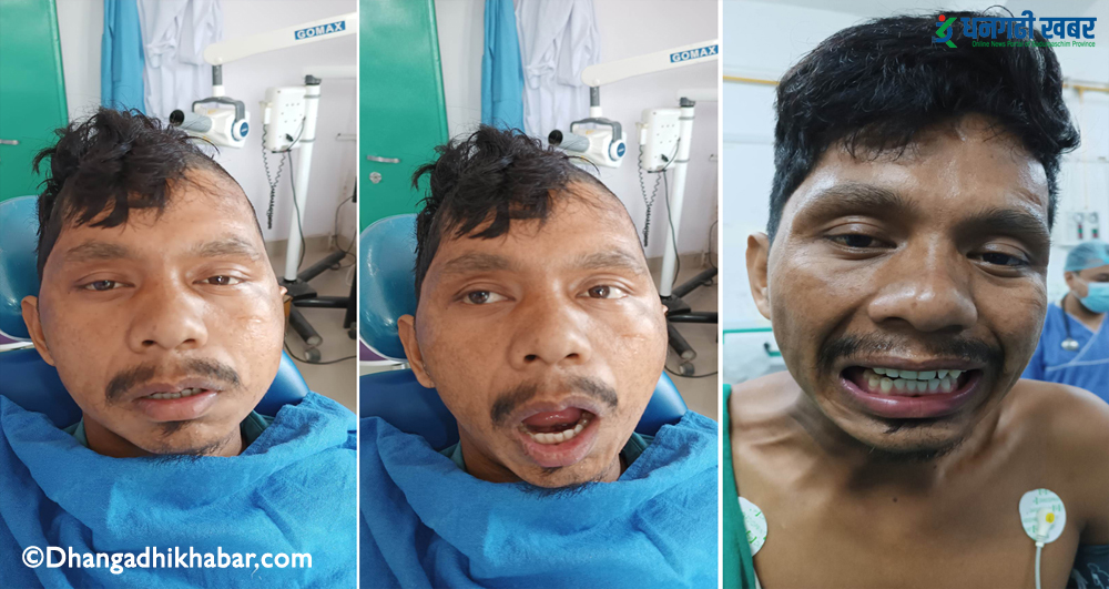 सेतीमा २० वर्षदेखि मुख खाेल्न नसक्ने विरामीकाे सफल शल्यक्रिया